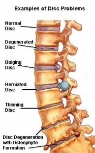 disc bulge disc herniation